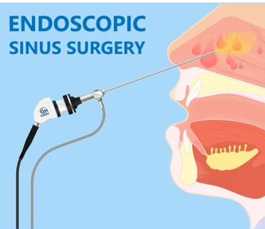 Debunking Common Myths About Sinus Surgery: The Truth You Need to Know